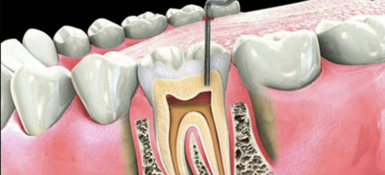 The Scary Truth About Root Canal Treatments